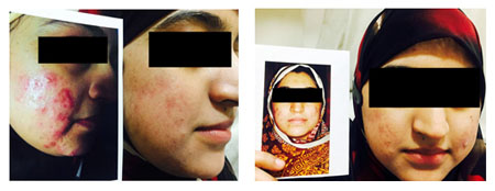 Acne Treatment in Ultadanga