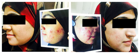 Acne Treatment in Rabindra Sadan