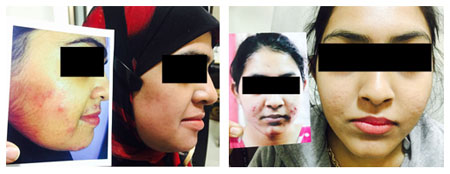 Acne Scar Treatment in Kolkata