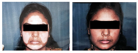 Vitiligo Specialist in Rabindra Sadan