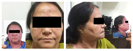 Chemical Peels Specialist in India