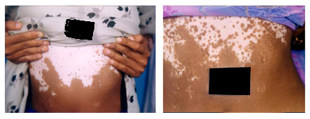 Vitiligo Treatment in Rabindra Sadan