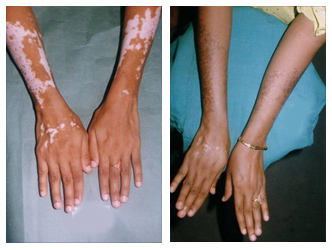 Vitiligo Treatment Cost in Salt Lake