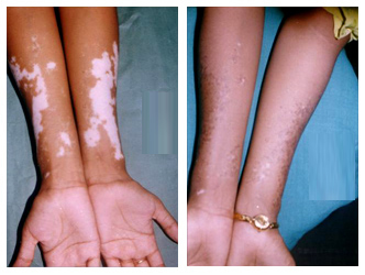 Vitiligo Treatment Cost in Ultadanga