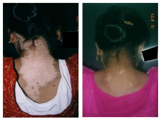 Vitiligo Treatment Cost in Rabindra Sadan