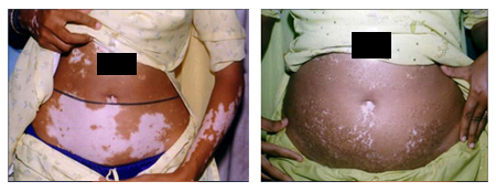 Vitiligo Treatment Doctor in India