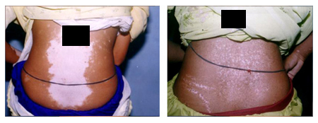 Vitiligo Treatment Specialist in India