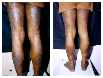 Psoriasis Treatment Cost in Rabindra Sadan