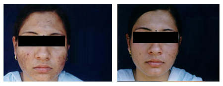 Acne Scar Treatment in Rabindra Sadan