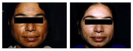 Chemical Peeling for Skin Whitening in Kolkata