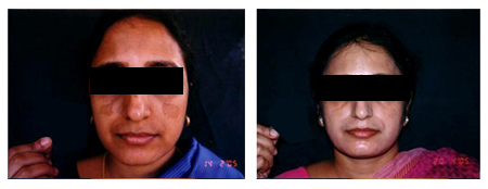 Chemical Peels Specialist in Ultadanga