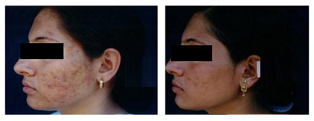 Acne Scar Treatment in India