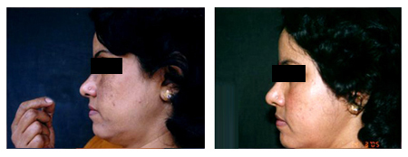 Chemical Peels Specialist in Rabindra Sadan