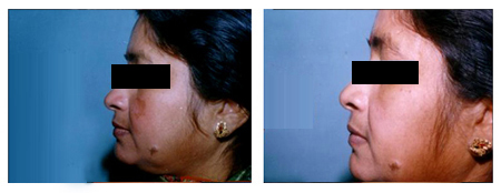 Chemical Peels Pigmentation in Kolkata