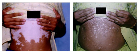 Vitiligo Treatment in Kolkata