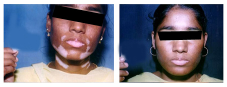 Vitiligo Treatment in Salt Lake