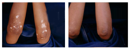 Vitiligo Treatment in Ultadanga