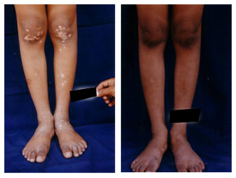 Vitiligo Treatment Cost in Kolkata